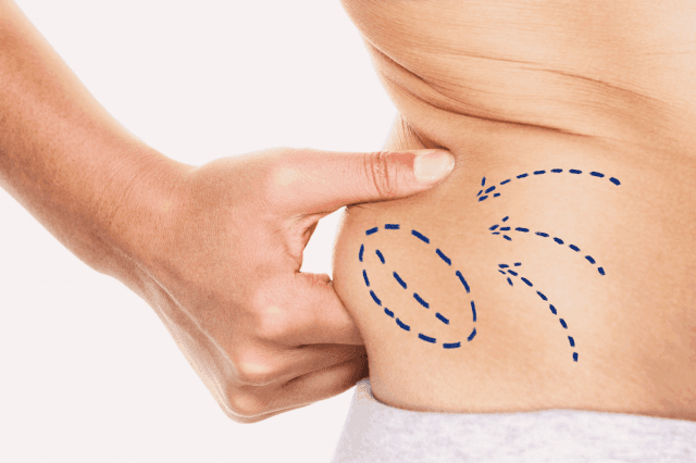 Discover the Ultimate Guide to Liposuction in Dubai: Your Path to a Sculpted Body!